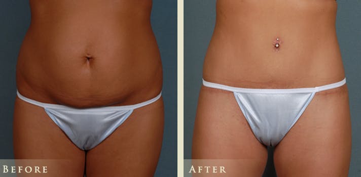 Tummy Tuck Before & After Gallery - Patient 785225 - Image 1