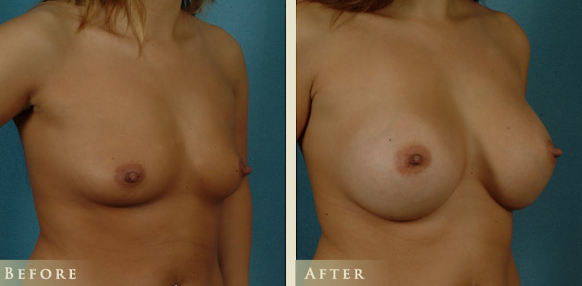 Breast Augmentation with Saline Implants Before & After Gallery - Patient 117143 - Image 2