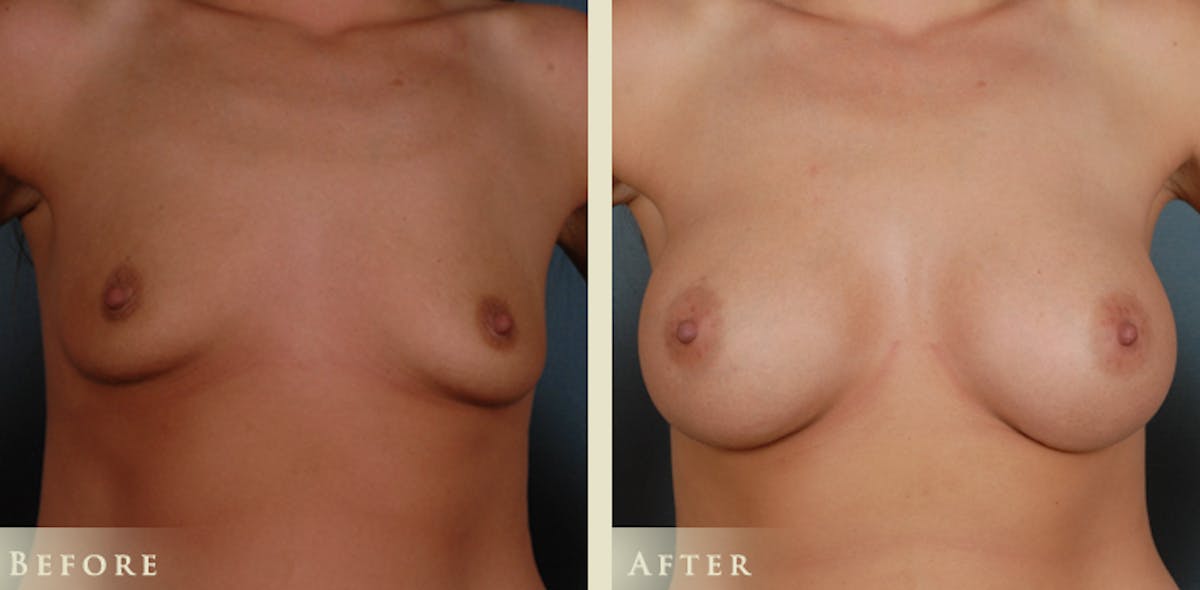 Breast Augmentation with Silicone Implants Before & After Gallery - Patient 365687 - Image 1
