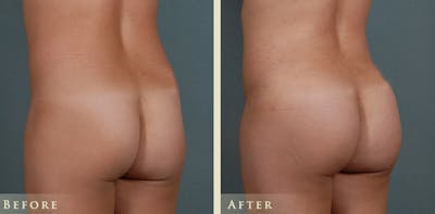 Brazilian Butt Lift Before & After Gallery - Patient 414358 - Image 2