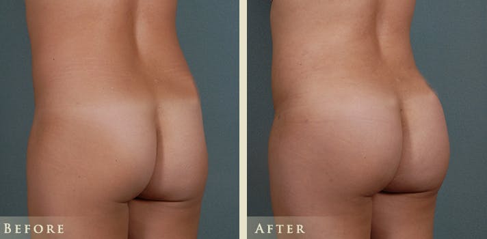 Brazilian Butt Lift Before & After Gallery - Patient 414358 - Image 2