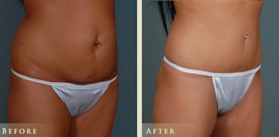 Tummy Tuck Before & After Gallery - Patient 785225 - Image 2