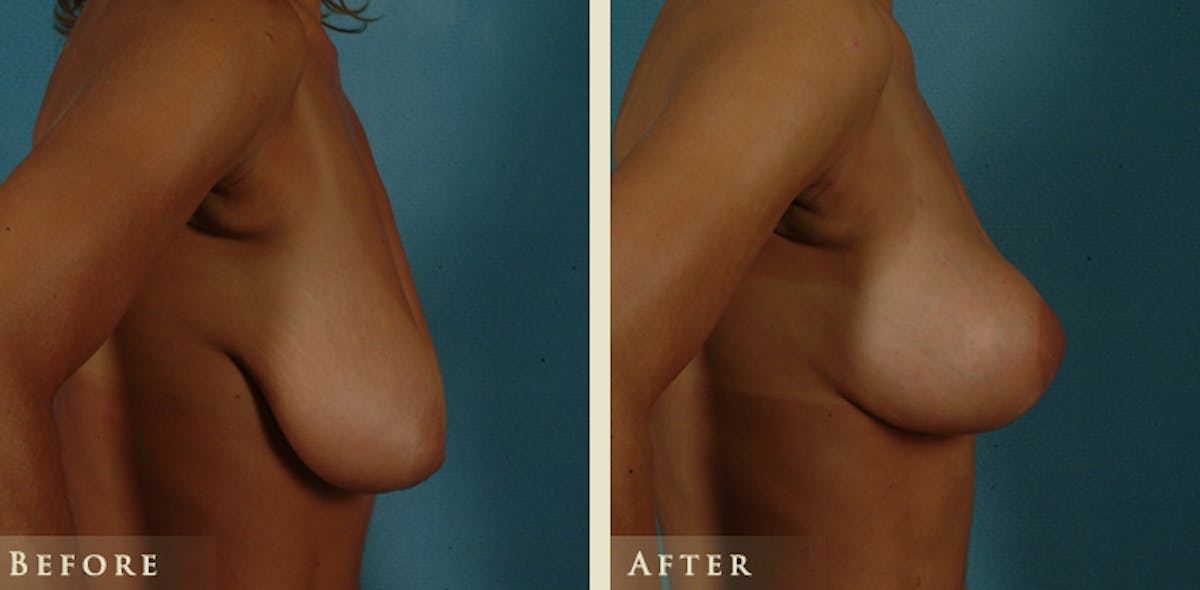 Breast Lift Before & After Gallery - Patient 333820 - Image 3