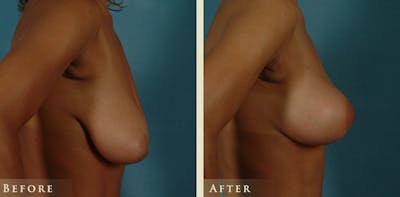 Breast Lift Before & After Gallery - Patient 333820 - Image 3