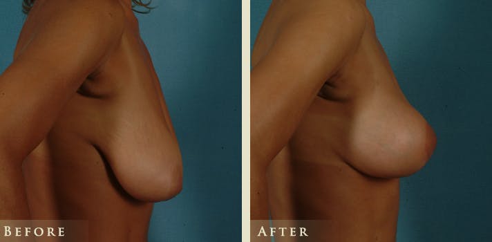 Breast Lift Before & After Gallery - Patient 333820 - Image 3
