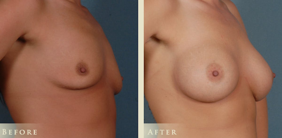 Breast Augmentation with Silicone Implants Before & After Gallery - Patient 365687 - Image 2