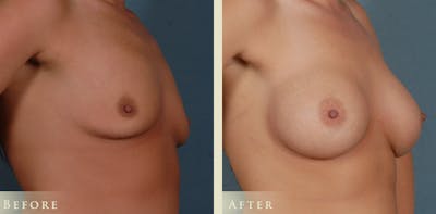 Breast Augmentation Before & After Gallery - Patient 365687 - Image 2