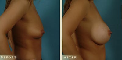 Breast Augmentation Before & After Gallery - Patient 365407 - Image 3
