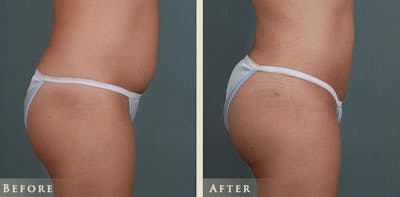 Brazilian Butt Lift Before & After Gallery - Patient 414358 - Image 3