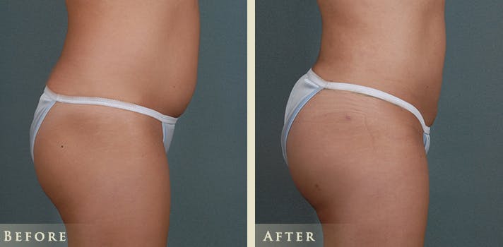 Brazilian Butt Lift Before & After Gallery - Patient 414358 - Image 3