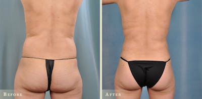 Female Liposuction Before & After Gallery - Patient 159448 - Image 5