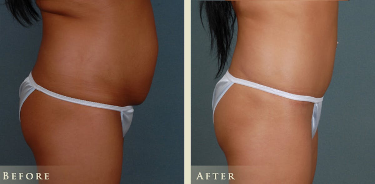 Tummy Tuck Before & After Gallery - Patient 785225 - Image 3