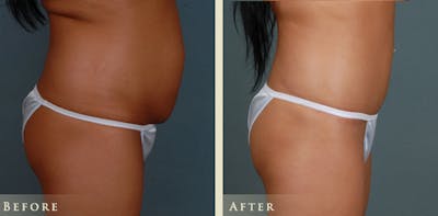 Tummy Tuck Before & After Gallery - Patient 785225 - Image 3