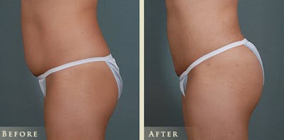 Brazilian Butt Lift Before & After Gallery - Patient 414358 - Image 4
