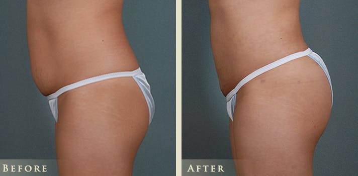 Brazilian Butt Lift Before & After Gallery - Patient 414358 - Image 4