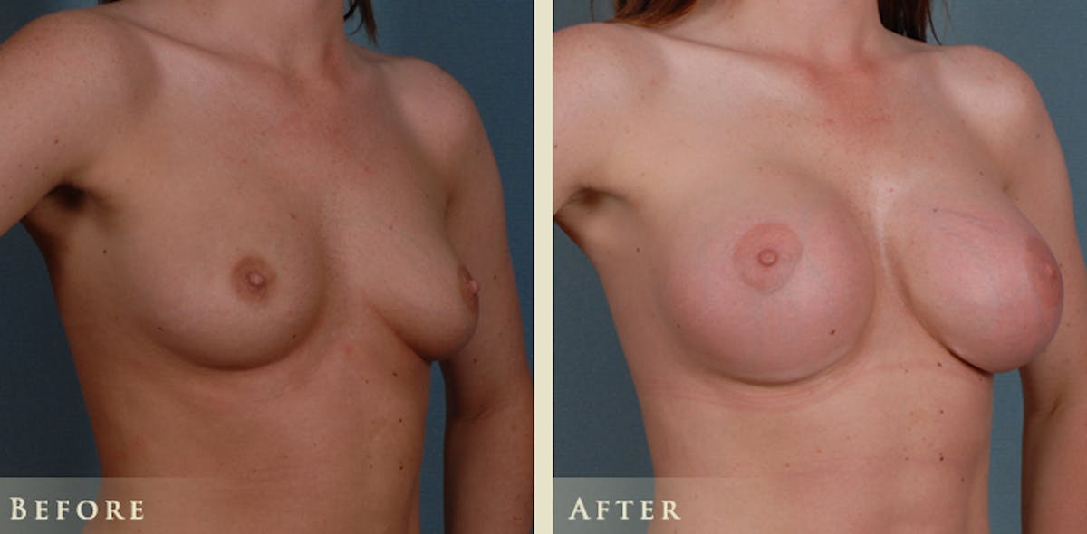 Breast Augmentation with Silicone Implants Before & After Gallery - Patient 970174 - Image 1