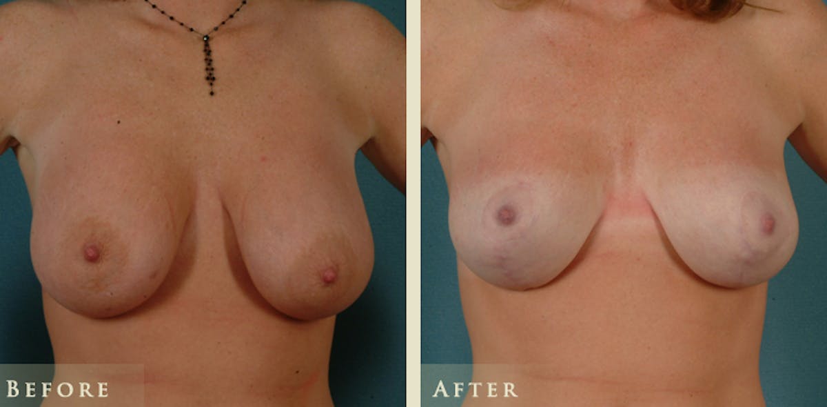 Breast Lift and Reduction Before & After Gallery - Patient 153338 - Image 1