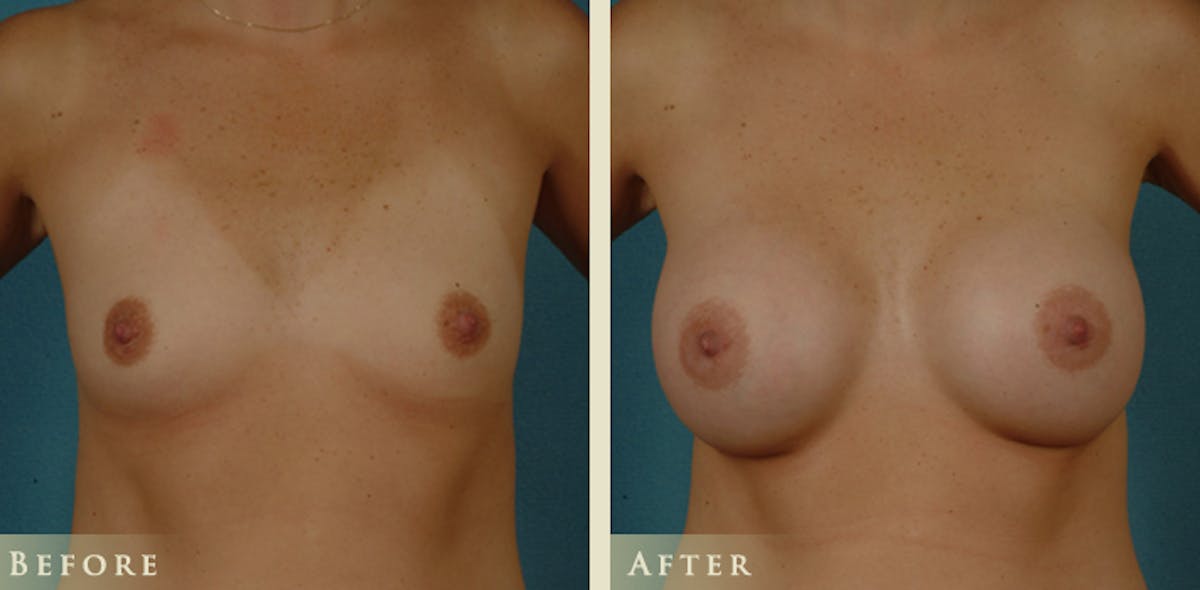 Breast Augmentation with Saline Implants Before & After Gallery - Patient 406716 - Image 1