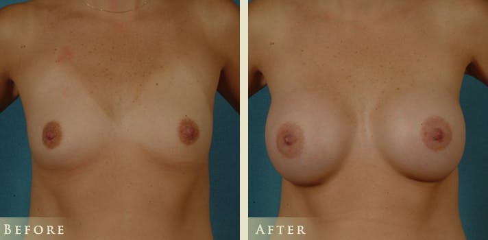Breast Augmentation Before & After Gallery - Patient 301571 - Image 1