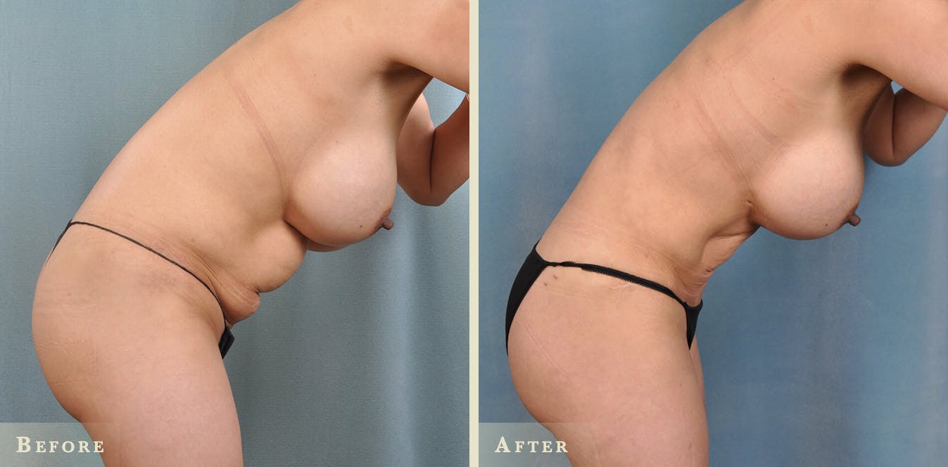 Female Liposuction Before & After Gallery - Patient 159448 - Image 6
