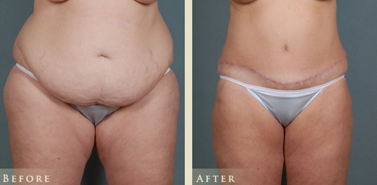 Tummy Tuck Before & After Gallery - Patient 175154 - Image 1