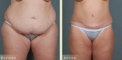 Tummy Tuck Before & After Gallery - Patient 175154 - Image 1