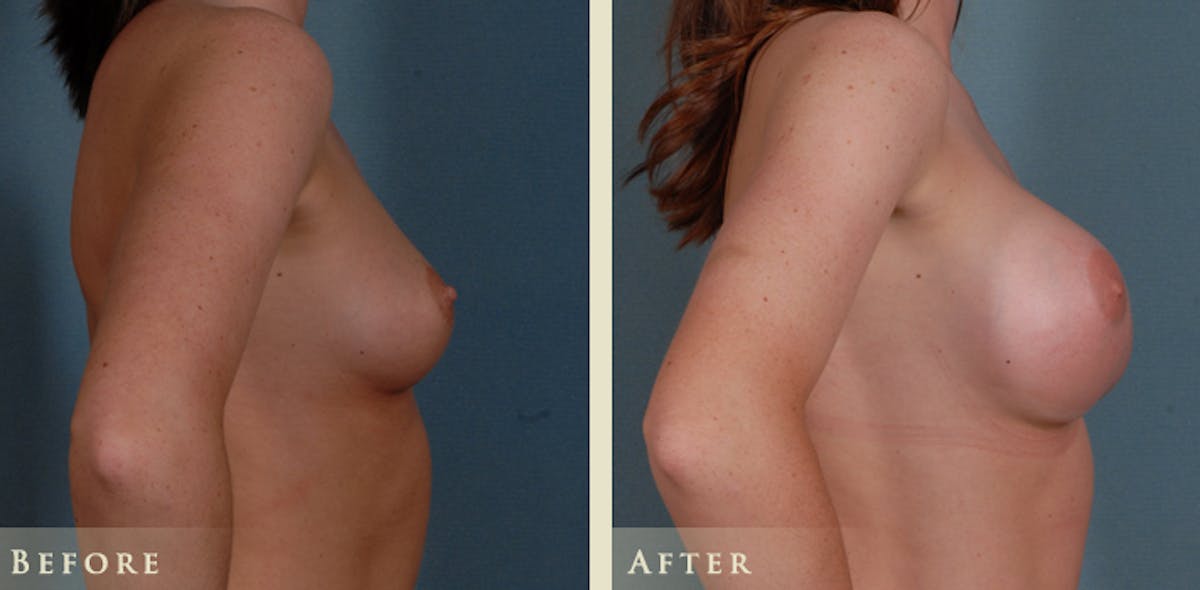 Breast Augmentation with Silicone Implants Before & After Gallery - Patient 970174 - Image 2