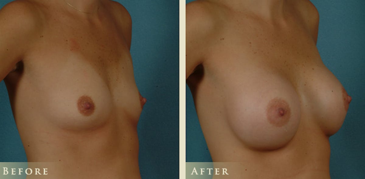 Breast Augmentation with Saline Implants Before & After Gallery - Patient 406716 - Image 2