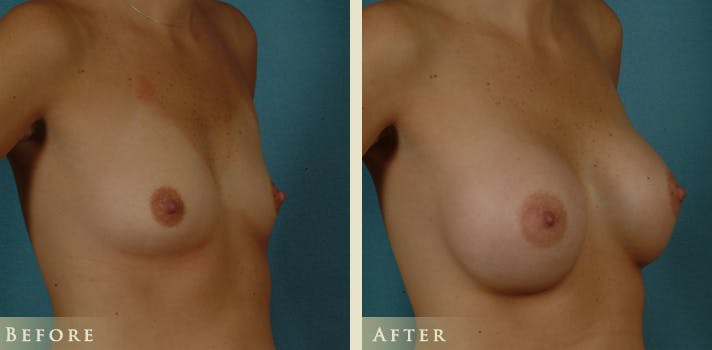 Breast Augmentation Before & After Gallery - Patient 301571 - Image 2