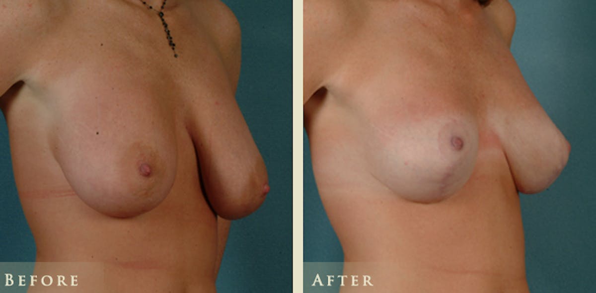 Breast Lift and Reduction Before & After Gallery - Patient 153338 - Image 2