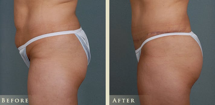Brazilian Butt Lift Before & After Gallery - Patient 210943 - Image 1
