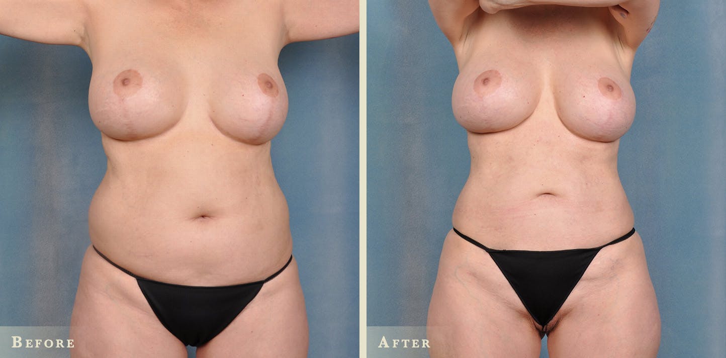 Female Liposuction Before & After Gallery - Patient 104024 - Image 1
