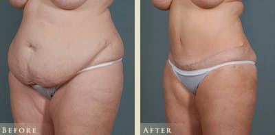 Tummy Tuck Before & After Gallery - Patient 175154 - Image 2