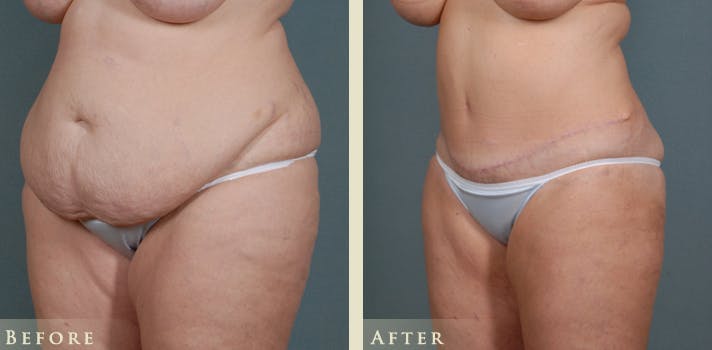 Tummy Tuck Before & After Gallery - Patient 175154 - Image 2
