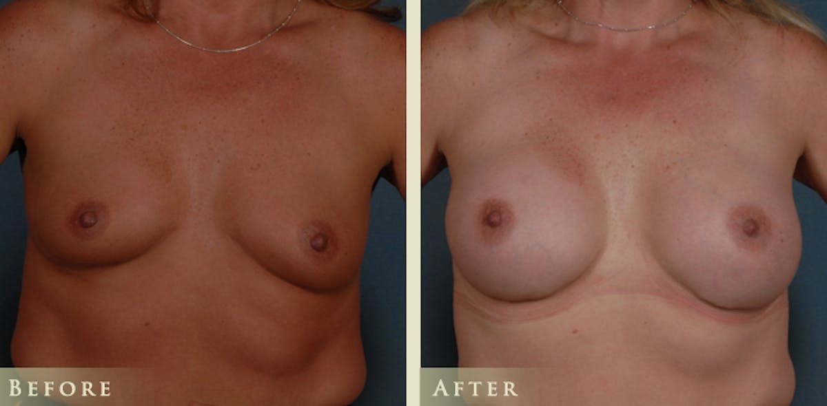 Breast Augmentation with Silicone Implants Before & After Gallery - Patient 173277 - Image 1