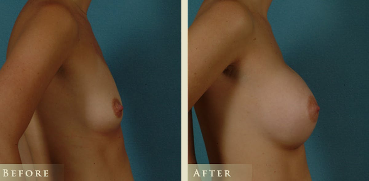 Breast Augmentation with Saline Implants Before & After Gallery - Patient 406716 - Image 3