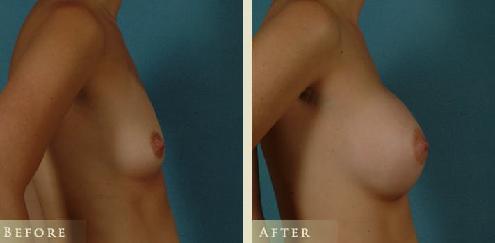 Breast Augmentation Before & After Gallery - Patient 301571 - Image 3