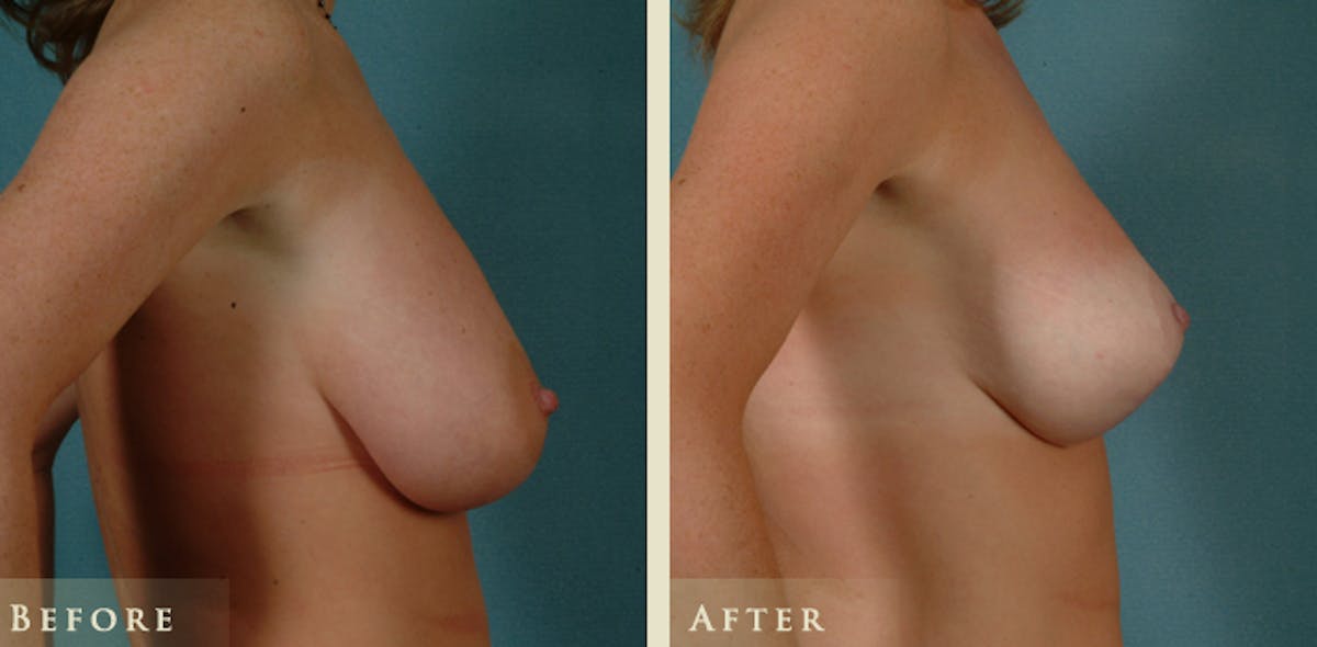 Breast Lift and Reduction Before & After Gallery - Patient 153338 - Image 3