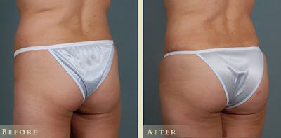 Brazilian Butt Lift Before & After Gallery - Patient 210943 - Image 2