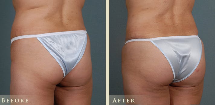 Brazilian Butt Lift Before & After Gallery - Patient 210943 - Image 2