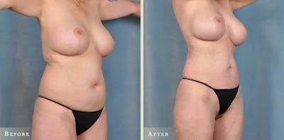Female Liposuction Before & After Gallery - Patient 104024 - Image 2