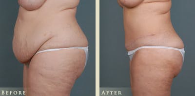Tummy Tuck Before & After Gallery - Patient 175154 - Image 3