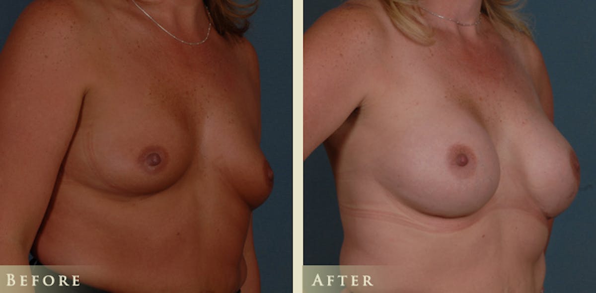 Breast Augmentation with Silicone Implants Before & After Gallery - Patient 173277 - Image 2