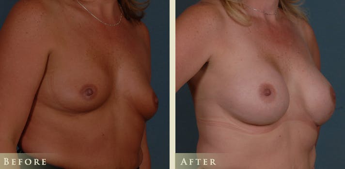 Breast Augmentation Before & After Gallery - Patient 173277 - Image 2