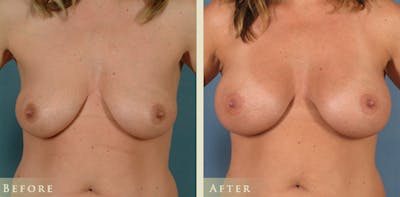 Breast Augmentation Before & After Gallery - Patient 248268 - Image 1