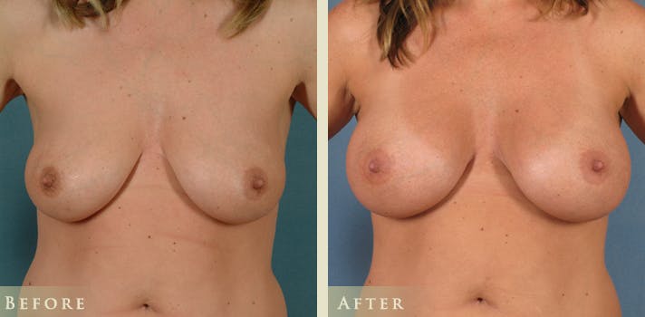 Breast Augmentation Before & After Gallery - Patient 248268 - Image 1