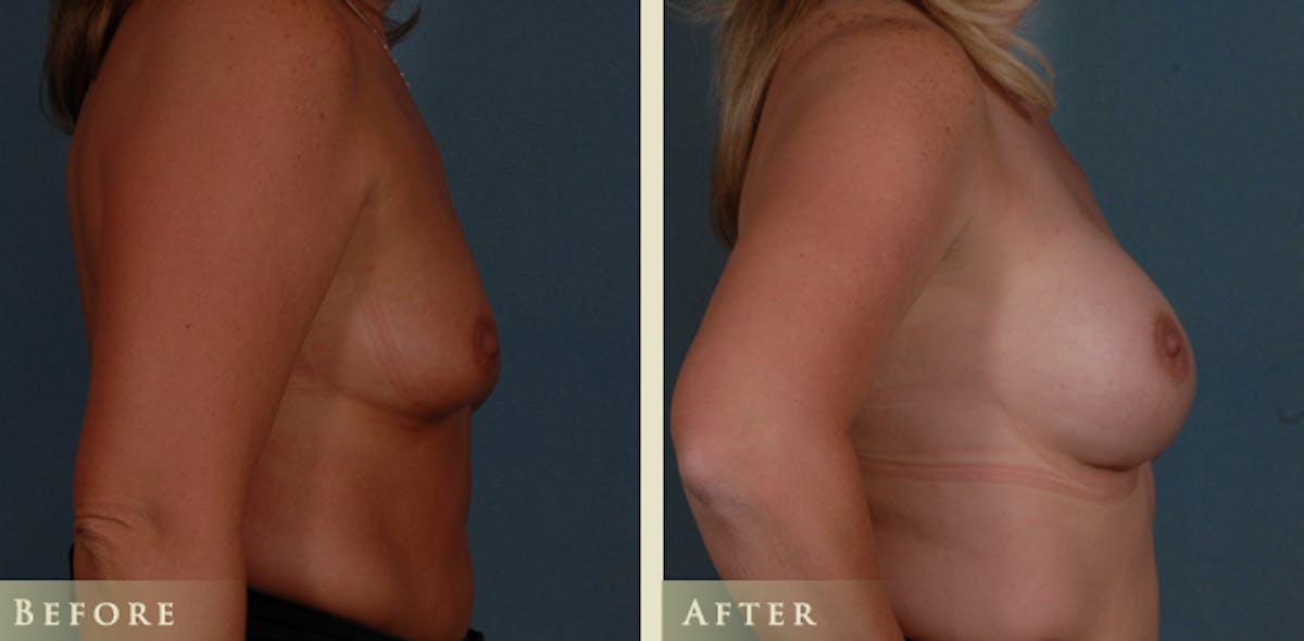 Breast Augmentation with Silicone Implants Before & After Gallery - Patient 173277 - Image 3
