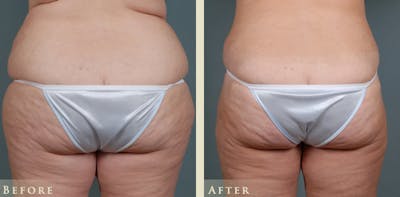 Tummy Tuck Before & After Gallery - Patient 175154 - Image 4