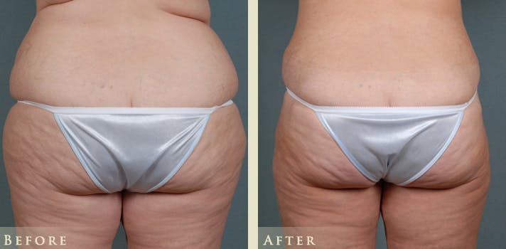Tummy Tuck Before & After Gallery - Patient 175154 - Image 4