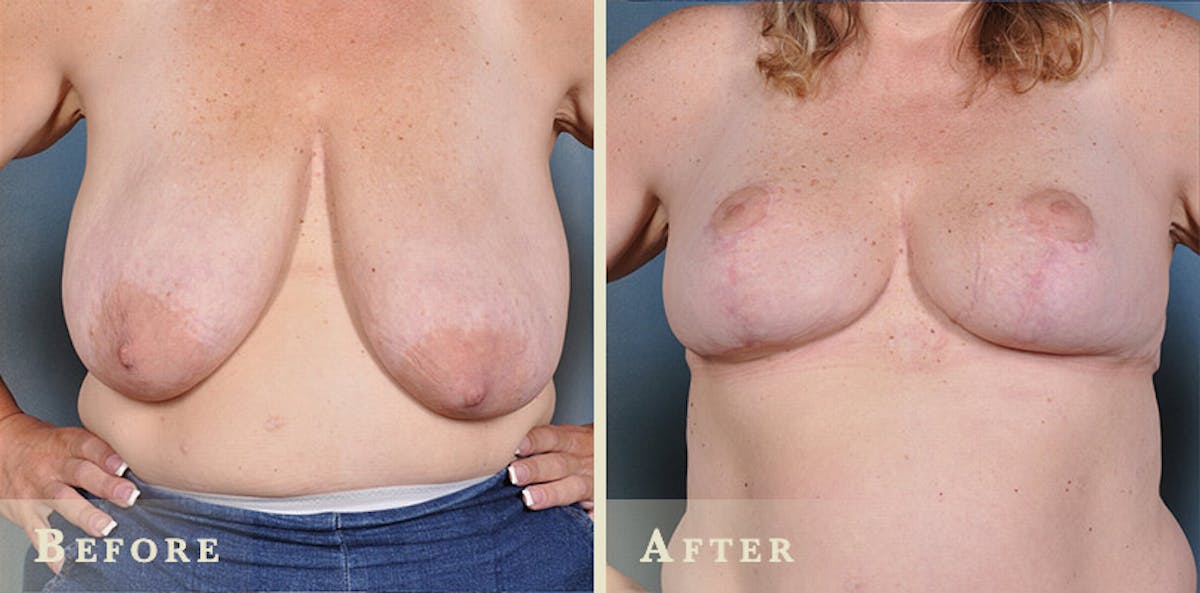 Breast Lift and Reduction Before & After Gallery - Patient 422628 - Image 1